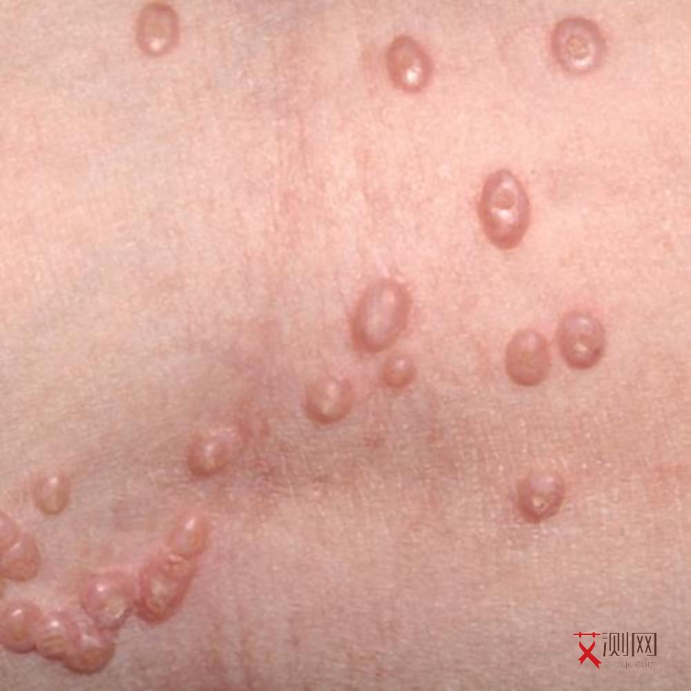 艾滋病前兆身体会痒吗会传染吗图片女