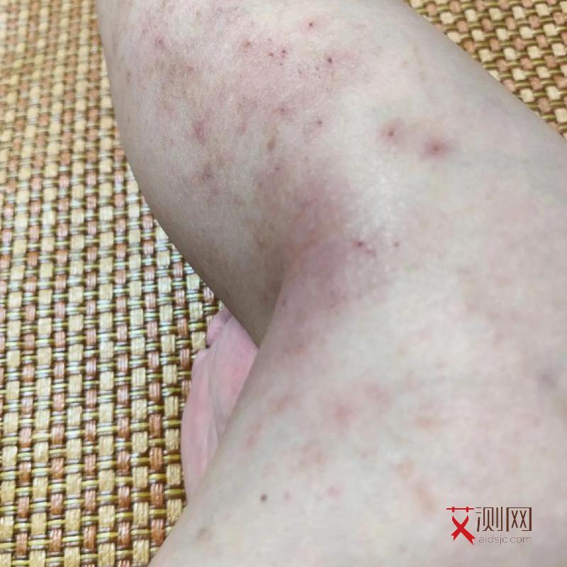 艾滋病的症状多久出现一次正常呢图片大全