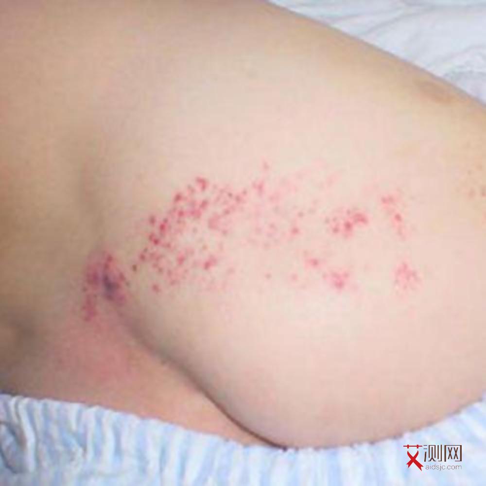 艾滋病在没有症状时不会传染吗为什么