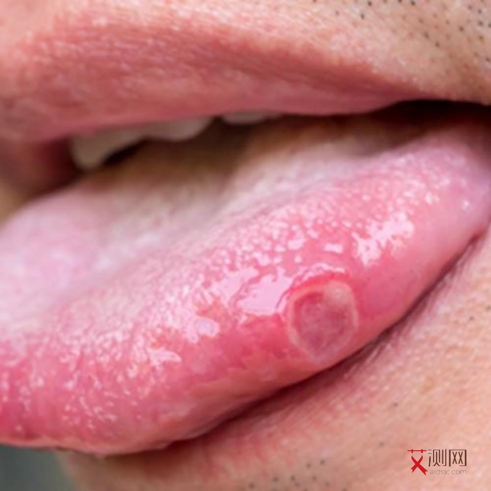 艾滋病皮疹多长时间