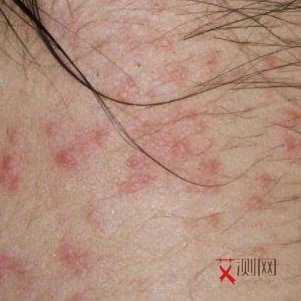 艾滋病下半身会痒吗图片女性