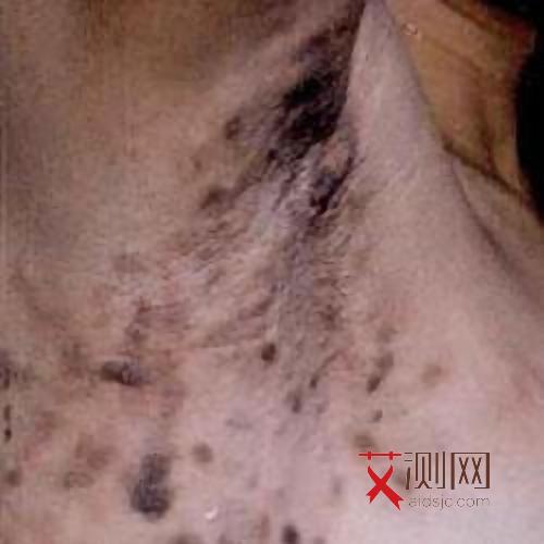 女性艾滋病症状初期征兆图片大全