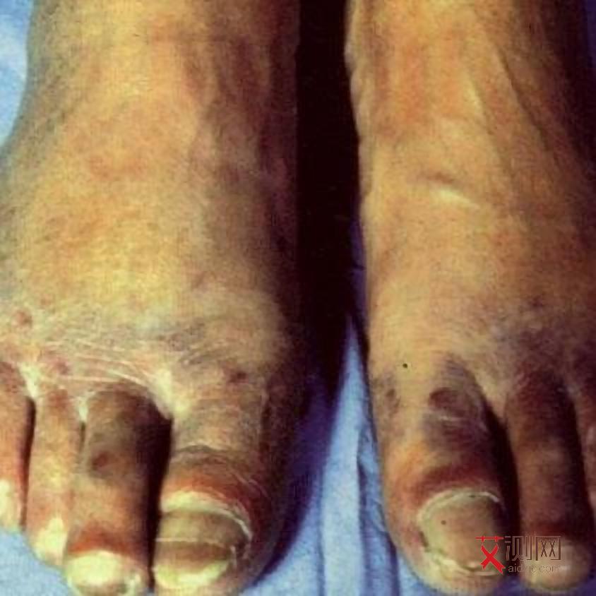 艾滋病什么时候会有症状出现