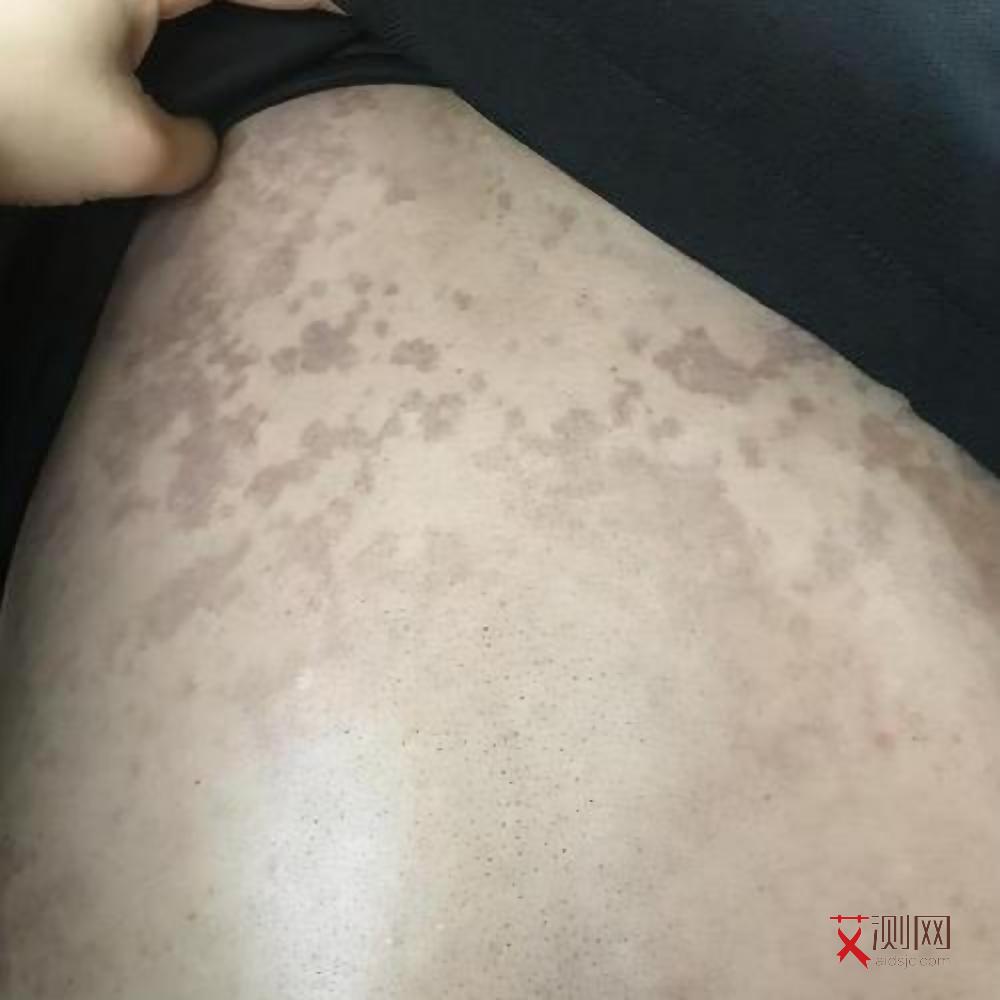 艾滋病人唾液能传染吗会传染吗