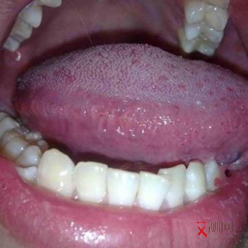 艾滋有症状后检测阴性