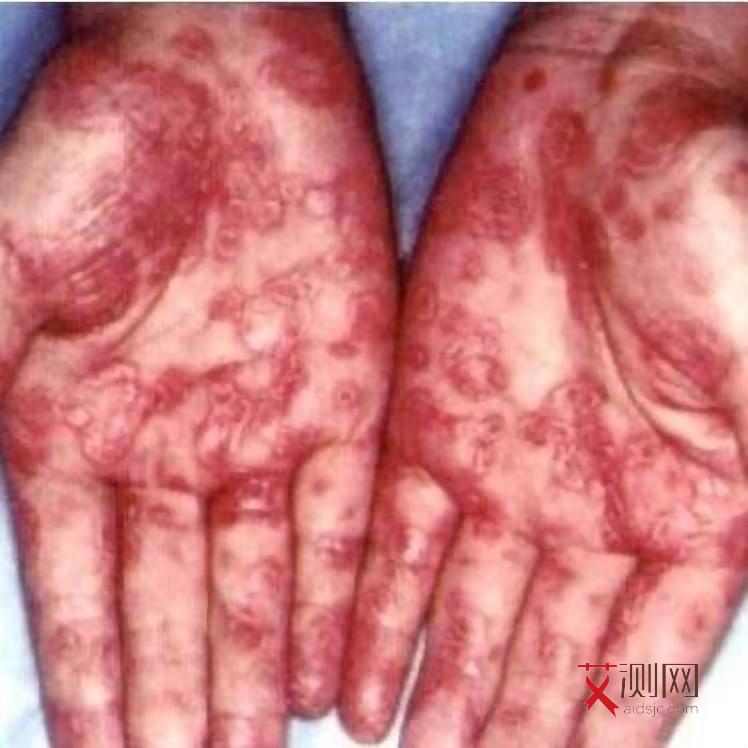 艾滋病红点会长在腿上吗图片真实