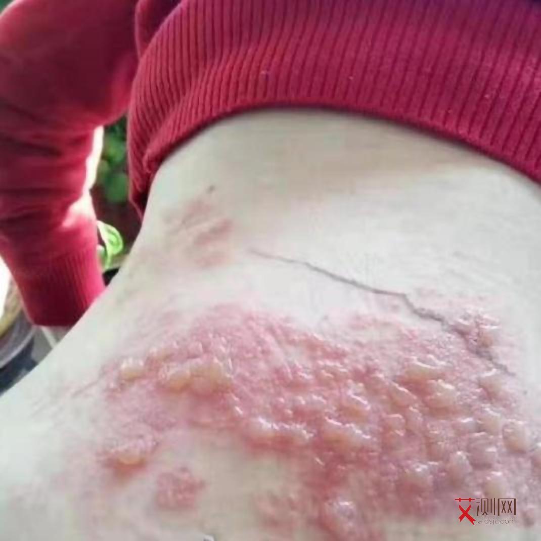 艾滋病感染初期腿部红疹