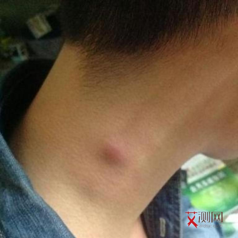 艾滋病梅毒多久发病