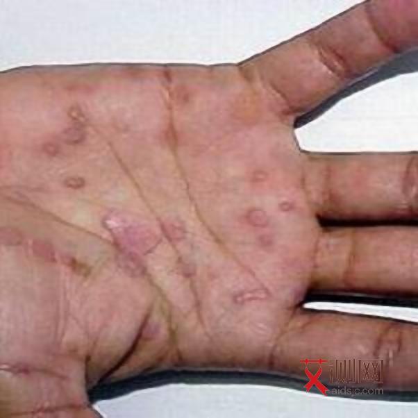 艾滋病会持续多久有症状呢图片