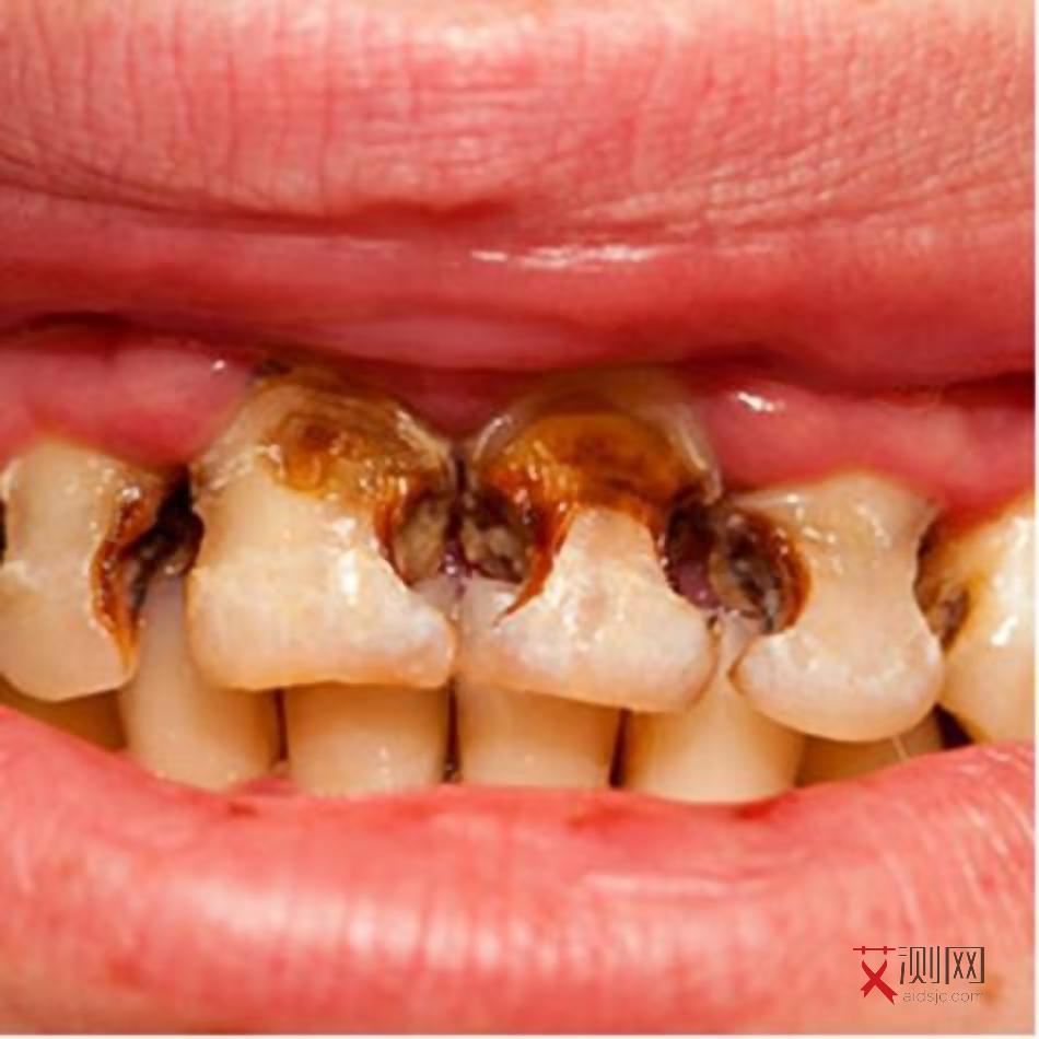 女性艾滋病患者照片