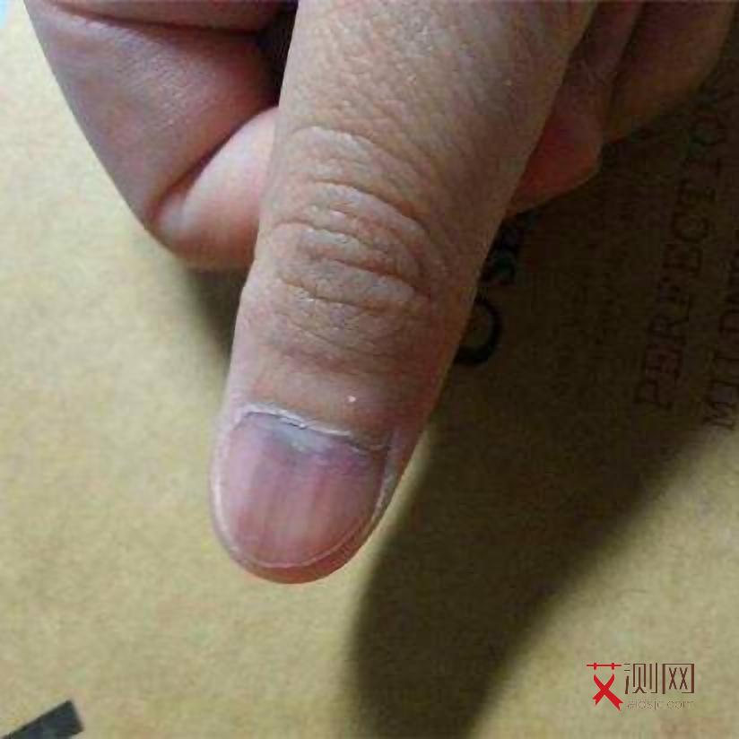 抓了艾滋病人的皮肤一下