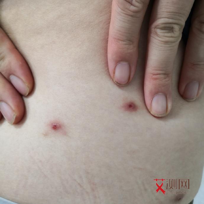 艾滋病的症状都有什么表现和症状女性吃什么药