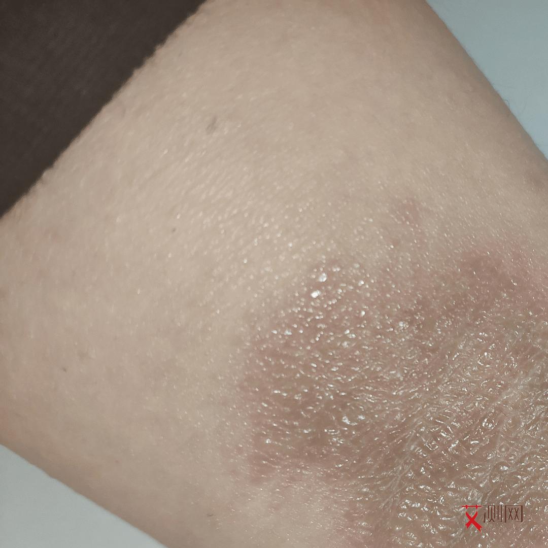 男的感染艾滋病有什么反应症状吗