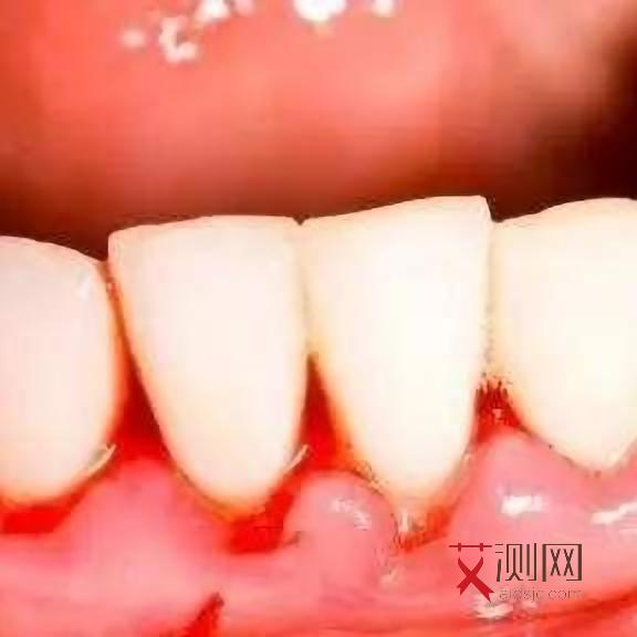 艾滋病男性的症状有哪些表现和症状图片大全