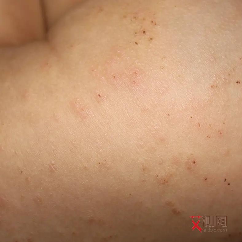 艾滋病症状特点有哪些