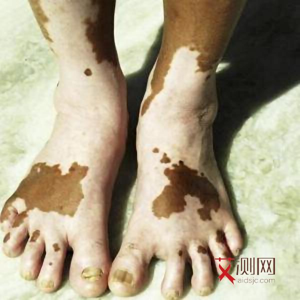 得了艾滋病有什么症状皮肤会痒也不来月经
