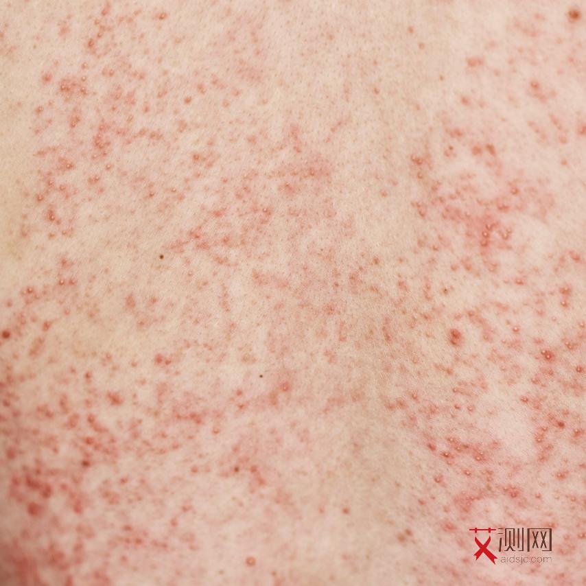 艾滋病外在症状图片