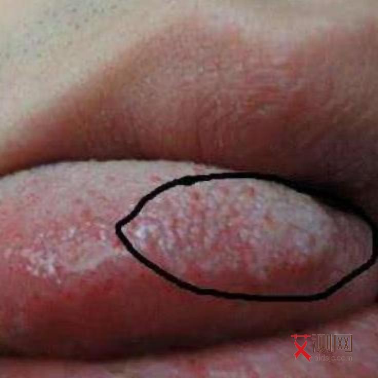 女性艾滋病下身会痒吗图片真实大全图解