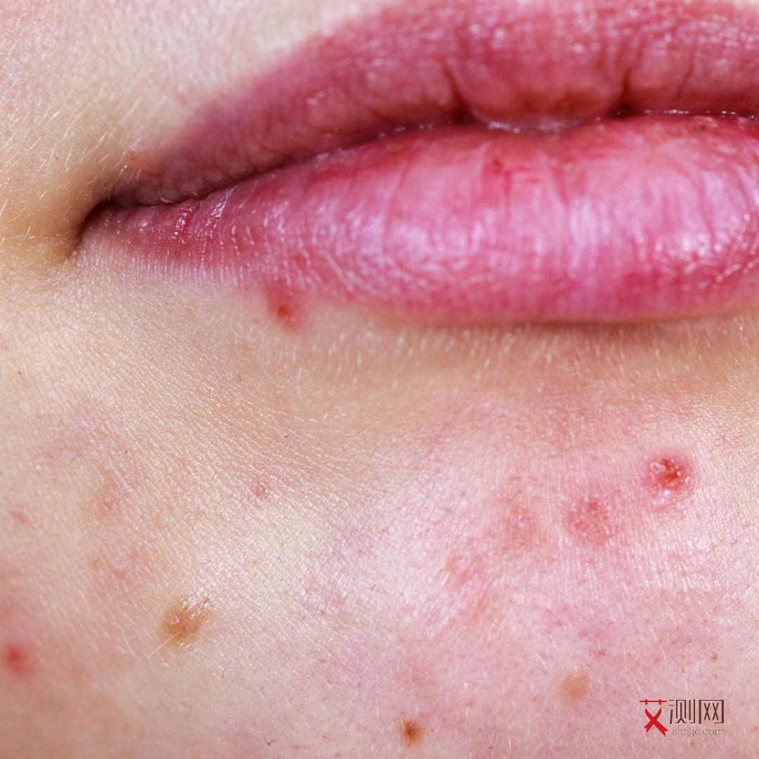 艾滋病早期症状红色斑疹症状图片大全