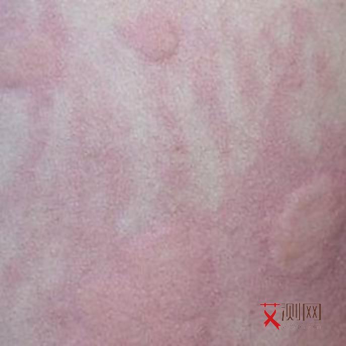 艾滋病最容易引发什么病