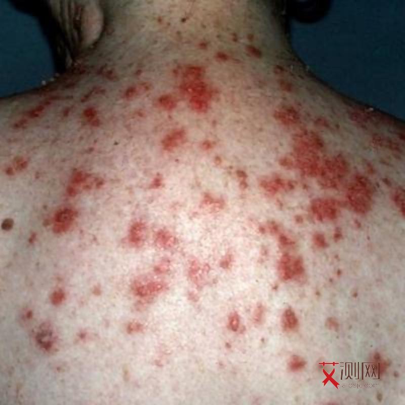 男性艾滋病患者下面有什么症状图片