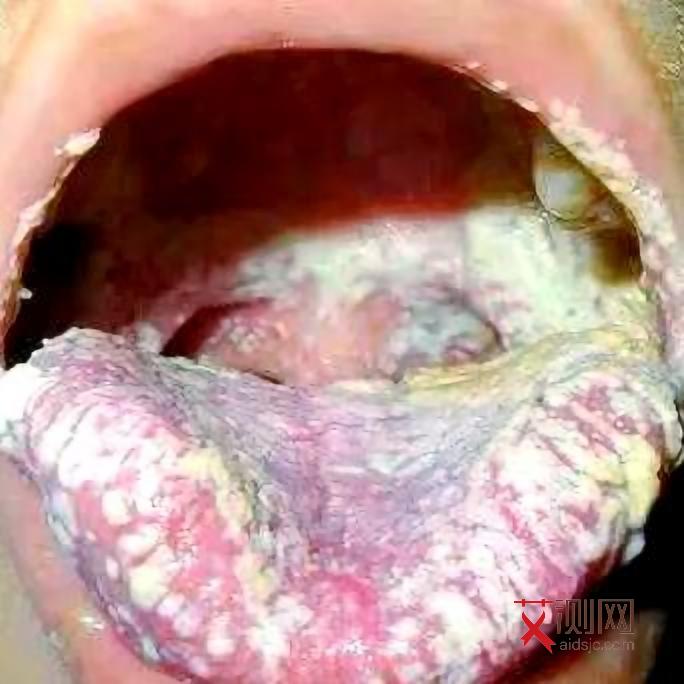 艾滋病多久会开始暴瘦百度知道