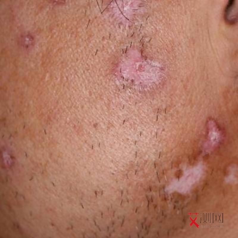 艾滋病早期皮肤损害症状图片女性怎么治疗好呢