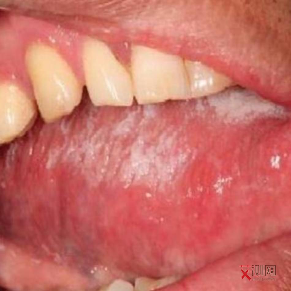 艾滋病初期小红点几天会消失