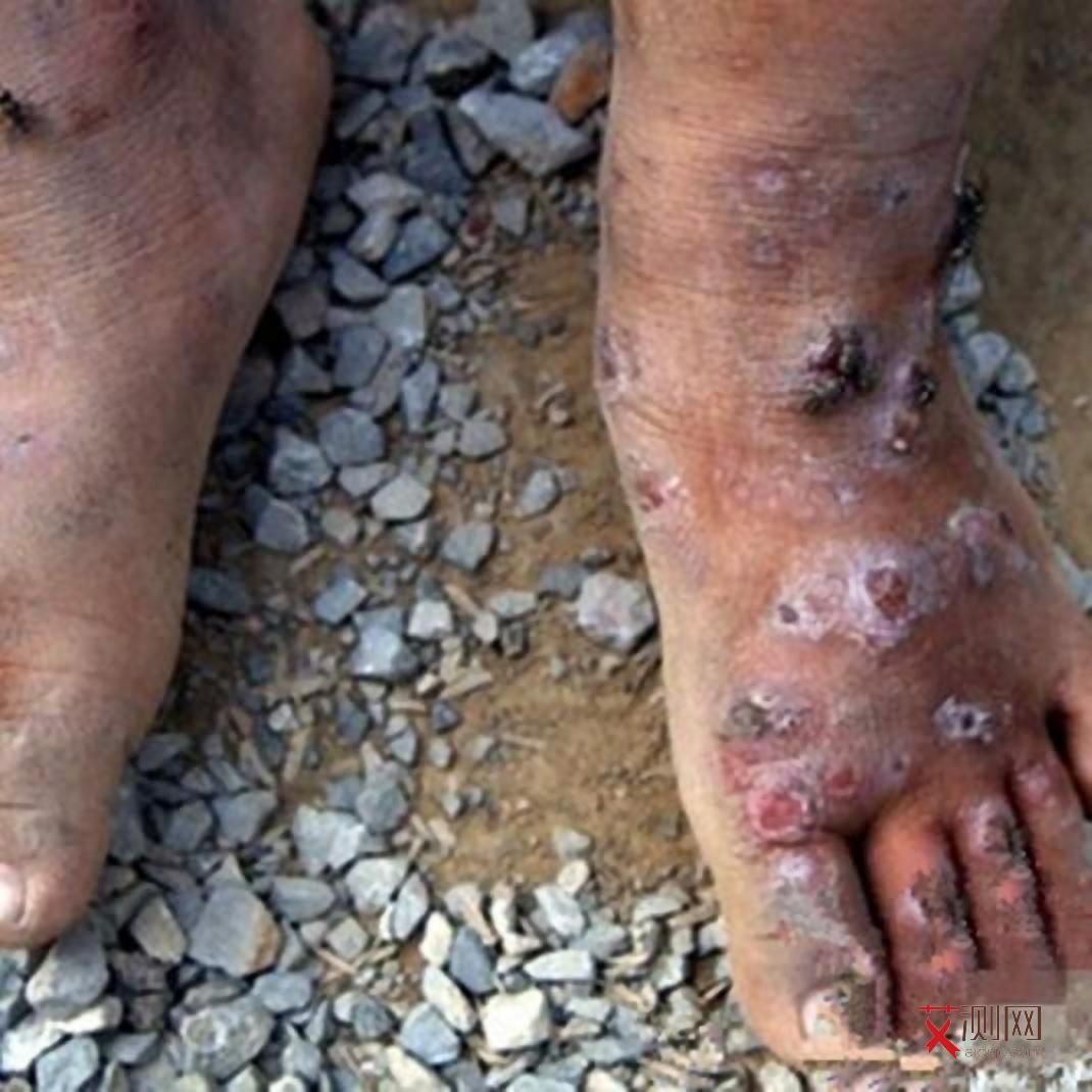 艾滋病多久发作症状会消失