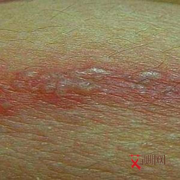 艾滋初期身体会痒吗图片