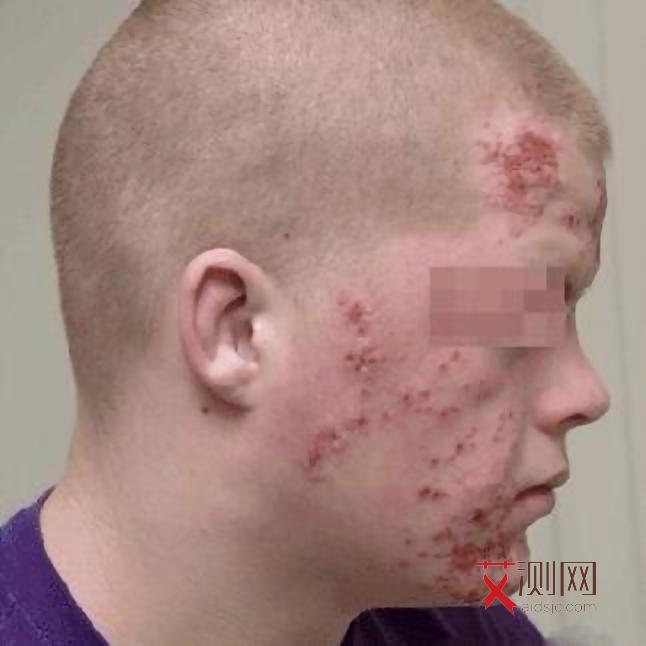 艾滋病病患者图片