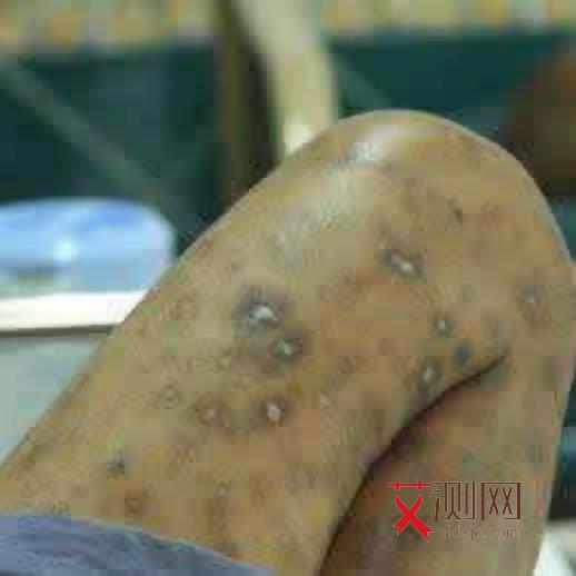 艾滋病有哪些症状女性初期表现