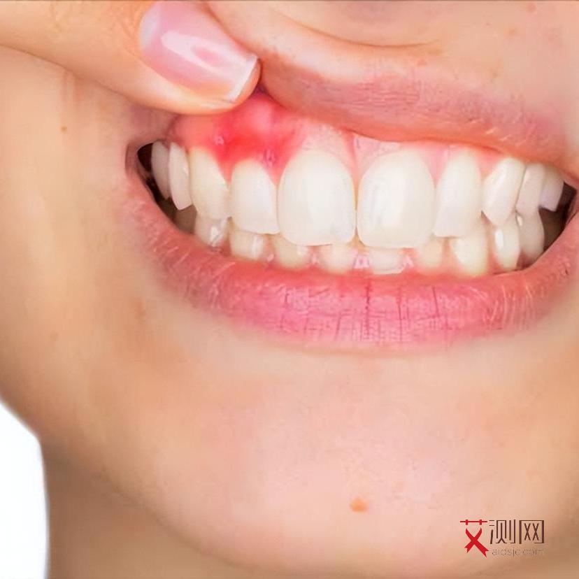 一般艾滋病多久有症状啊女性