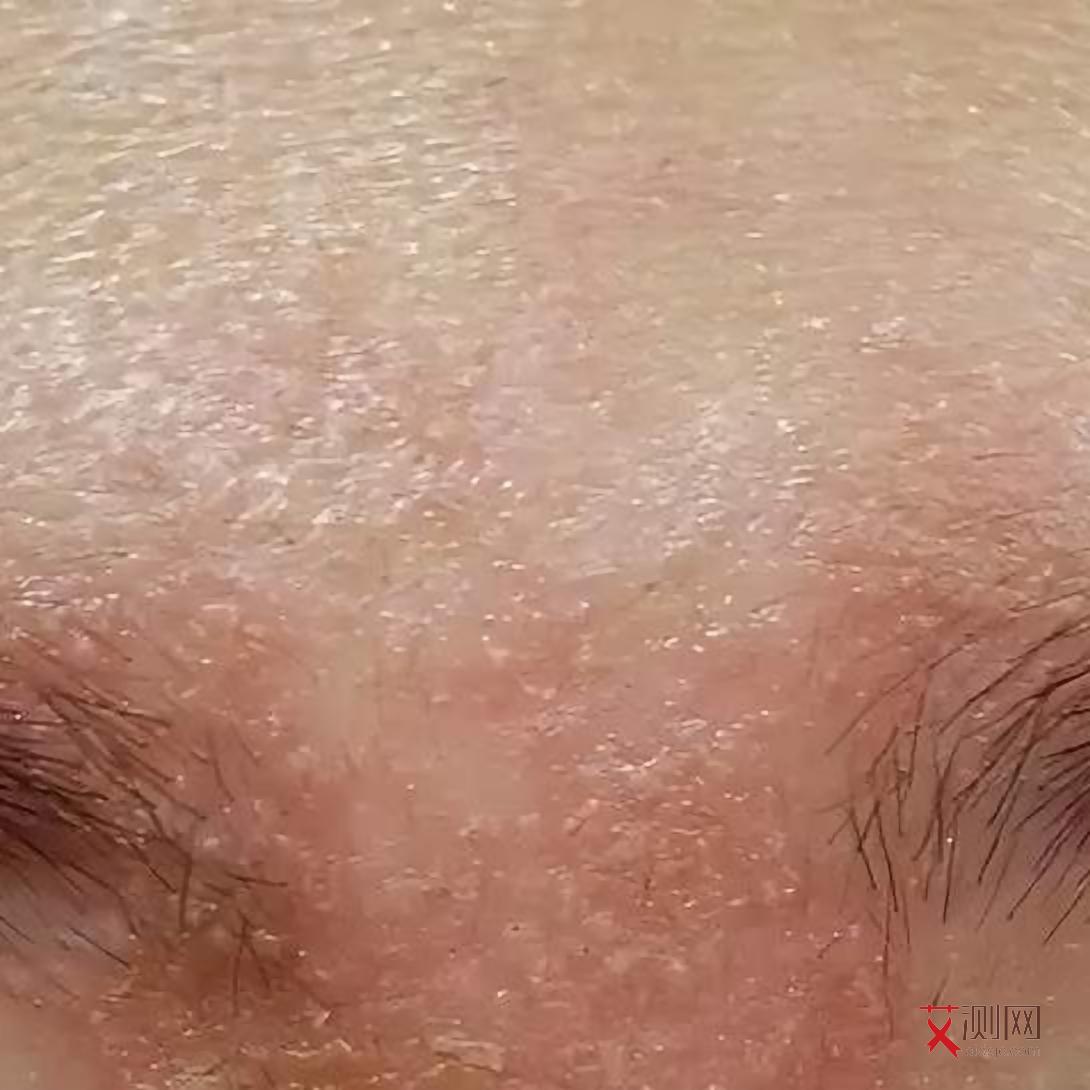 有在疾控中心感染艾滋病的吗现在