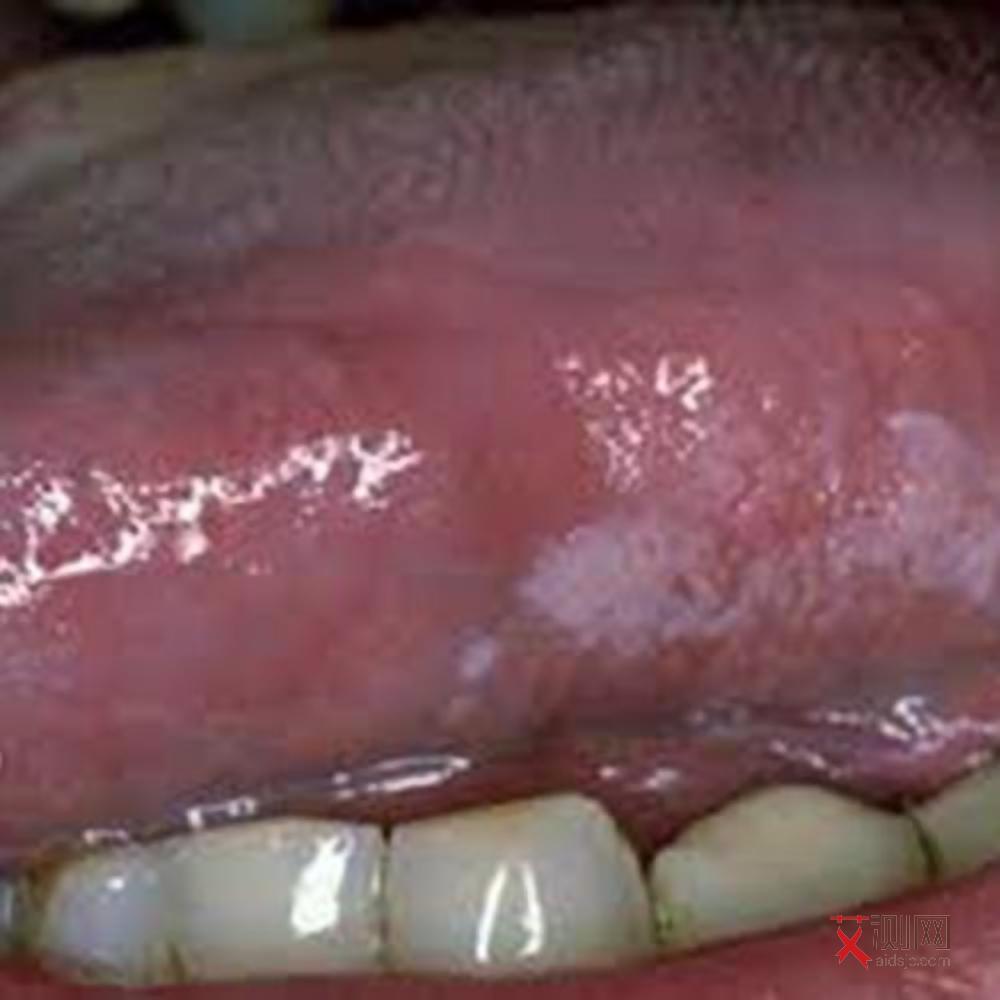 感染艾滋病多久淋巴结会肿起来呢图片大全