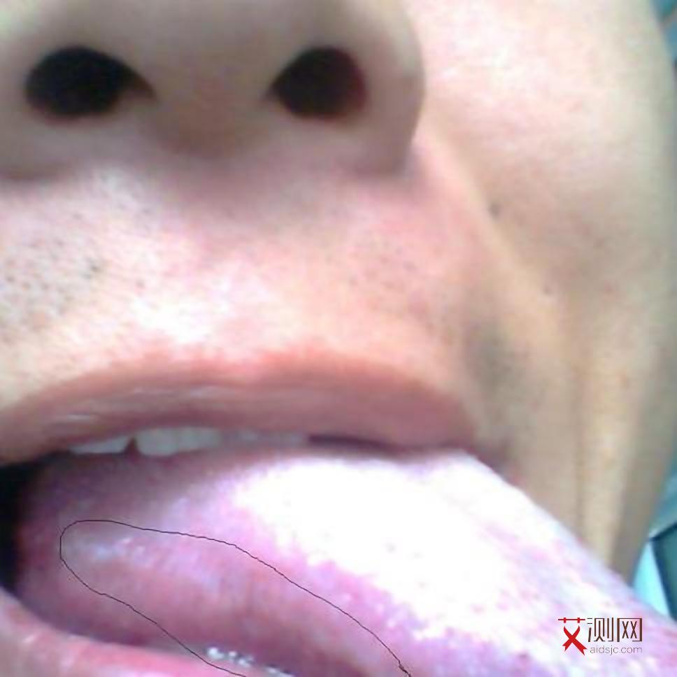 艾滋病导致淋巴结肿大是怎样的表现图片