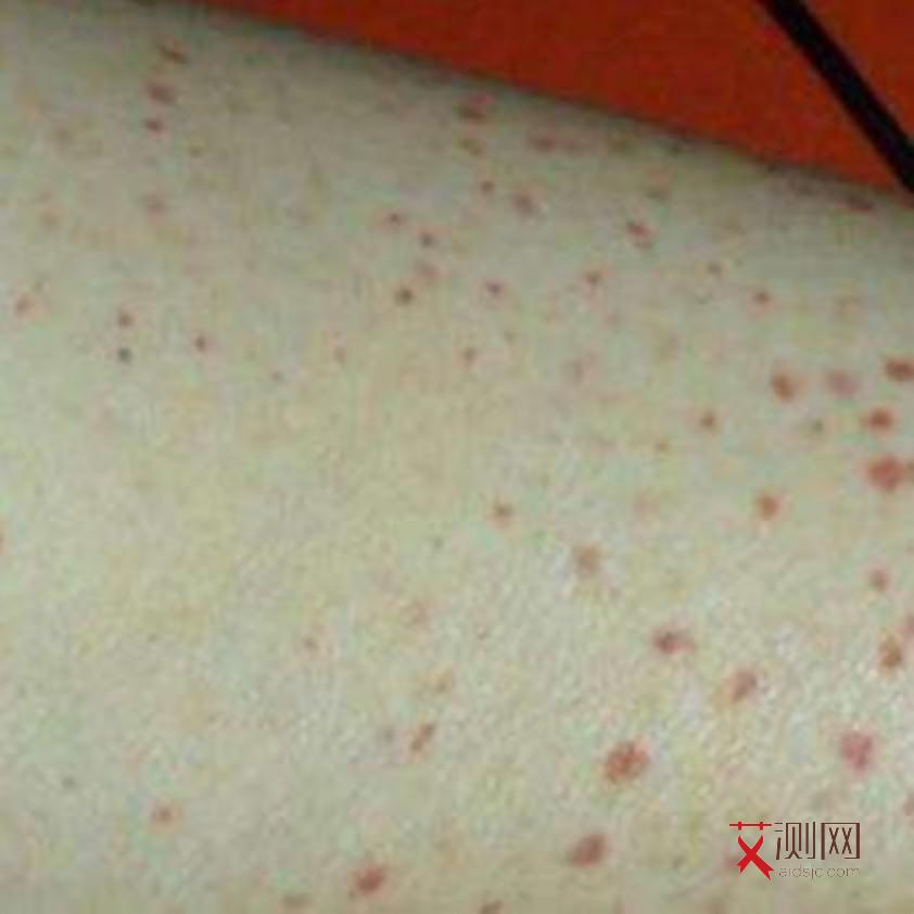 艾滋病初期小红点大吗会传染吗
