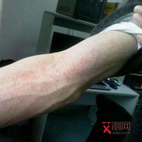 艾滋病身上起水泡了晚期吗