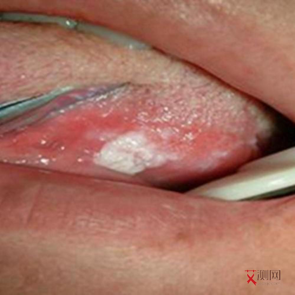 艾滋病初期会引发炎症吗会传染吗图片