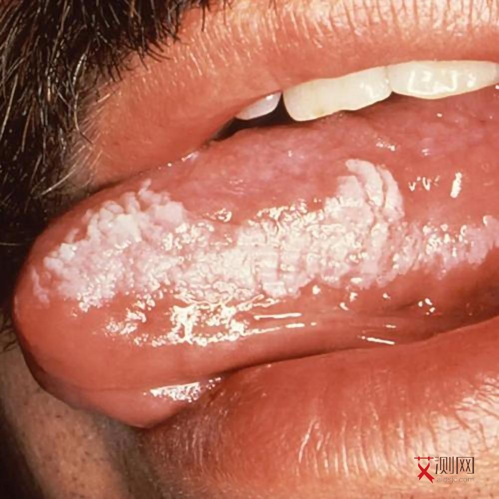 刚刚感染艾滋病怎么办