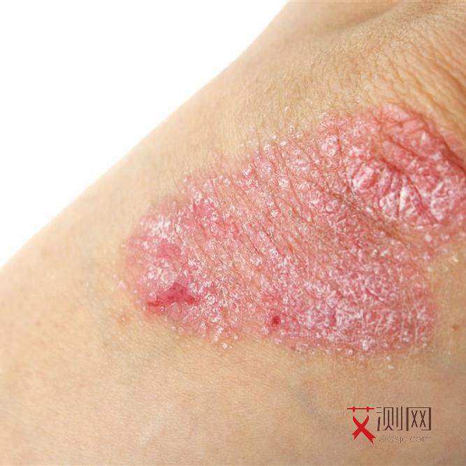 艾滋病发病的图片高清