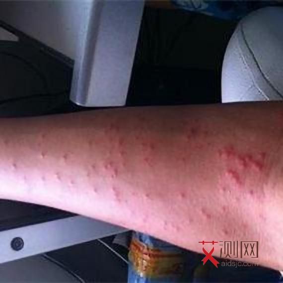 女性艾滋病身上的红点是怎样的症状图片