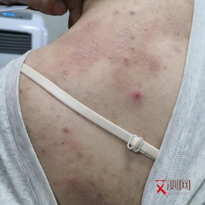 感染艾滋病后多久有症状