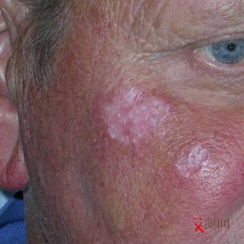 艾滋病人有什么症状表现呢女性