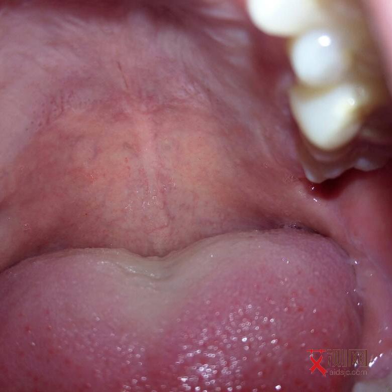 怎么判断自己有没有得艾滋病