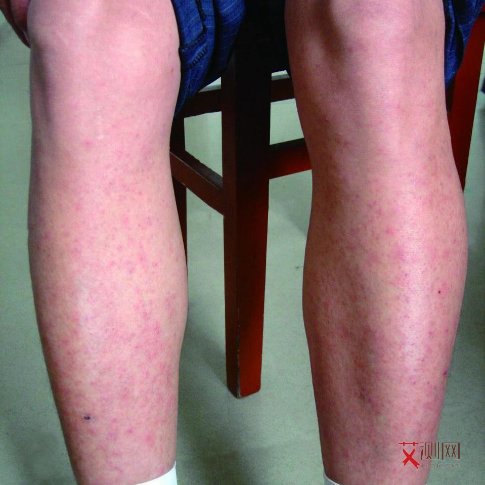 艾滋病初期小红点照片长在哪在哪