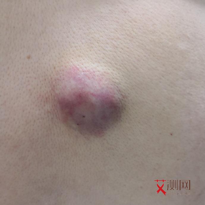 艾滋病女性下体臭不臭怎么判断