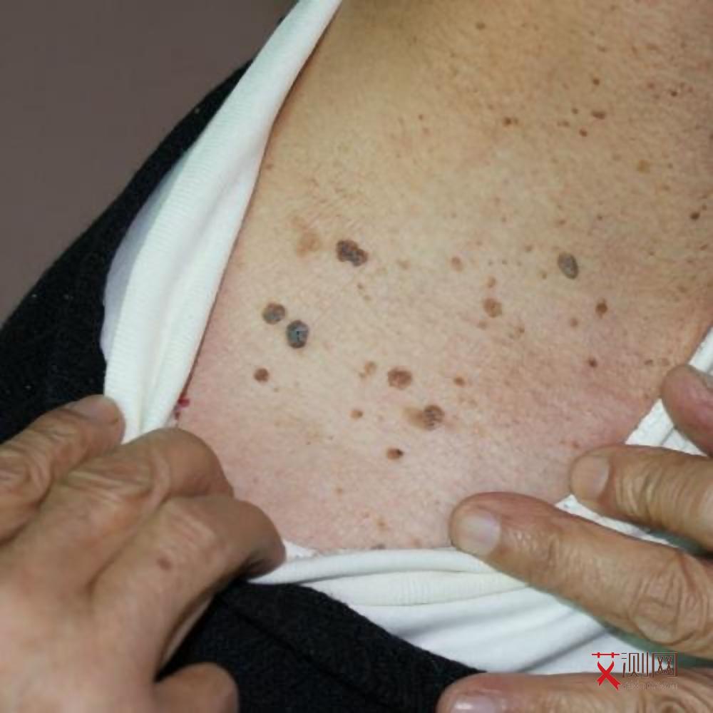 艾滋病男性前兆图片大全高清