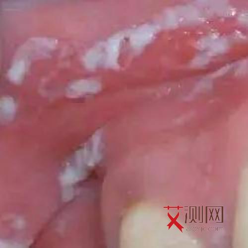 艾滋病感染口腔表征的诊断标准为