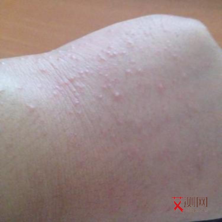 得艾滋病得症状是什么样子的